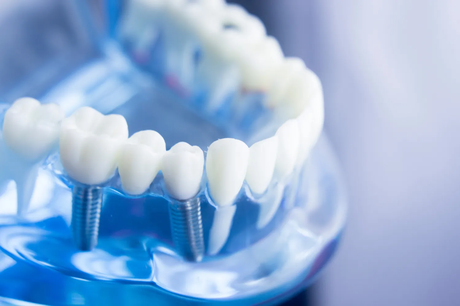Co trzeba wiedzieć o implantach zębowych?